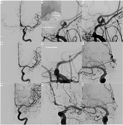 Indirect Flow Diversion for Off-Centered Bifurcation Aneurysms and Distant Small-Vessel Aneurysms, a Retrospective Proof of Concept Study From Five Neurovascular Centers